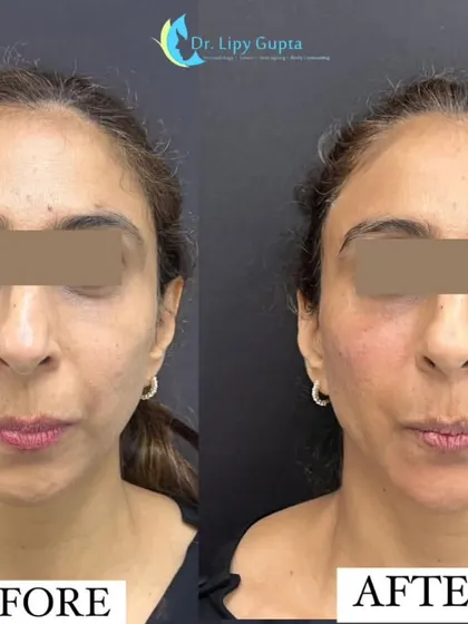 Tired-looking eyes are a major concern for many. With carefully placed under-eye fillers, I restored lost volume in the tear trough area, instantly reducing hollows and dark shadows for a brighter, more rested look.