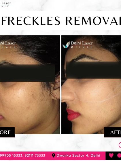 Freckles and sun spots can be effectively lightened with our Medlite C6 Q-Switch laser. This before-and-after shows a visible reduction in freckles, leading to a clearer and more uniform complexion.