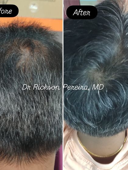This view of the crown shows a remarkable increase in hair density after eight months of consistent treatment. This result underscores the importance of patient compliance and trusting the medical process.