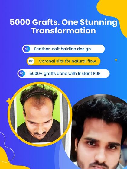 This is a complete hair transformation journey. With over 5000 grafts and our Instant FUE technique, we achieved a stunning, natural looking result with a feather soft hairline design.