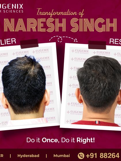 The complete transformation of Naresh Singh, showcasing a restored hairline and renewed look.