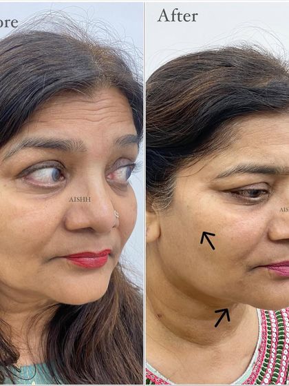 A side view of a cheek lift and saginess treatment for a 48-year-old patient. Adding volume to the cheeks provides a subtle lift to the entire lower face, reducing the appearance of jowls.