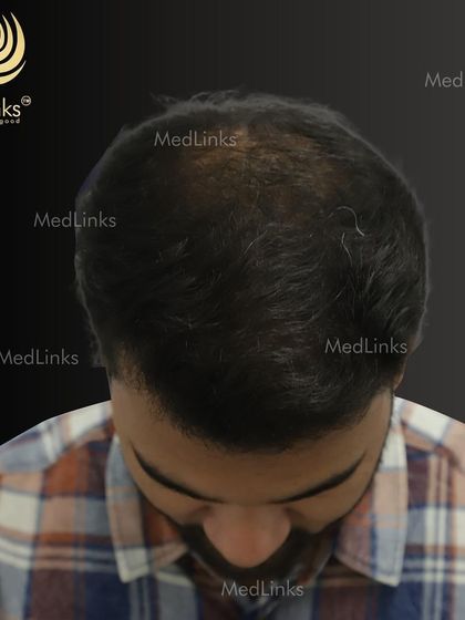 The top-down view after the transplant, showcasing the full coverage achieved.