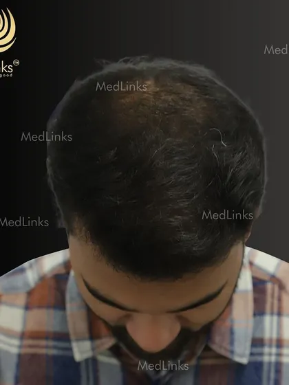 This client was experiencing significant thinning on the crown. Our hair transplant solution restored density and provided a natural, full look, completely transforming his appearance from the top.