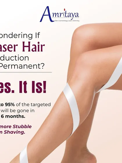 Is laser hair reduction permanent? Yes, it is! With our treatment plan, you can expect up to 95% of targeted hair to be gone in 5 to 6 months, eliminating stubble from shaving for good.