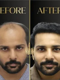 Hair Transplant Surgery