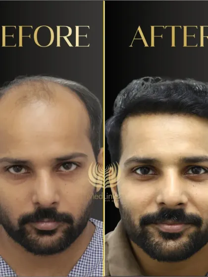This is what a life-changing transformation looks like. We don't just restore hair; we restore the confidence that comes with it. Using our advanced Perfect-i FUE technique, we create hairlines that are dense, natural, and perfectly suited to your face.