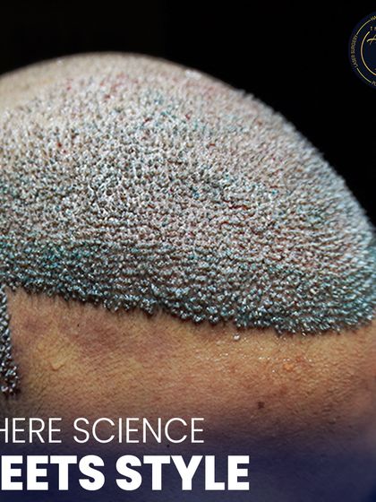 This side view demonstrates how we shape the temporal points, which are crucial for framing the face. Whether creating a masculine or feminine hairline, the angle and shape of this area are critical for a natural result.