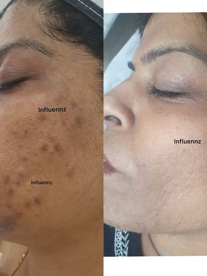 This transformation shows a remarkable improvement in both acne and deep-set pigmentation, restoring an even and smooth skin tone.