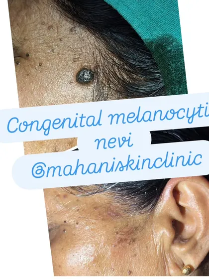 This shows the before and after of a surgical excision for a congenital melanocytic nevus, a type of birthmark. When performed with skill, we can achieve minimal scarring and reduce future health risks.