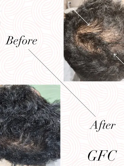 Another powerful GFC transformation. The arrows in the 'before' photo point to areas of significant thinning, which are visibly fuller and denser in the 'after' photo, demonstrating successful hair regeneration.