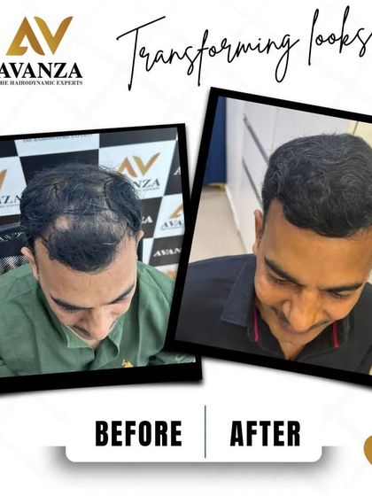 A fantastic transformation that showcases a significant increase in density and a well-defined hairline. The client looks happier and more confident in the after photo.