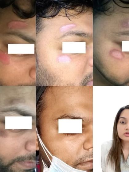 This collage shows the healing progression of an injury scar. Using a combination of treatments, we can significantly reduce the visibility of scars, especially when treatment is started early.
