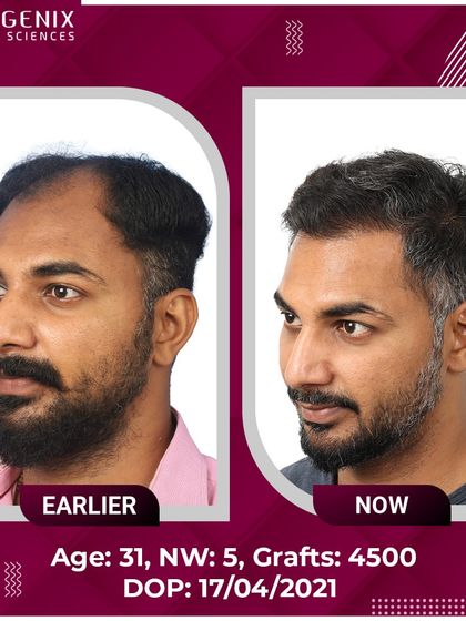 This 31-year-old patient's journey from Grade 5 hair loss to happiness with 4500 grafts.
