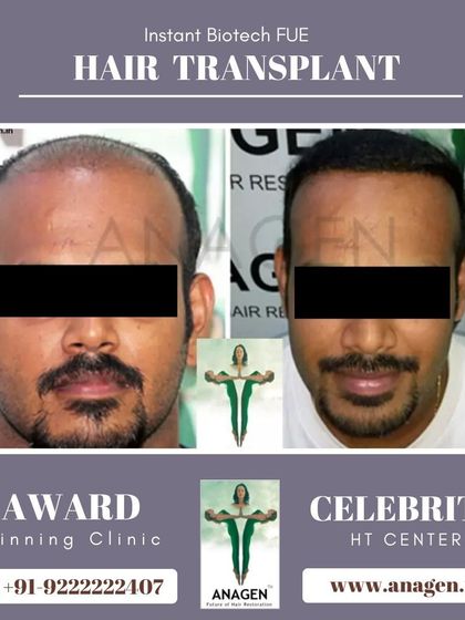 An amazing result from our Instant Biotech FUE hair transplant. This before and after photo shows a significant improvement in hair density and coverage.