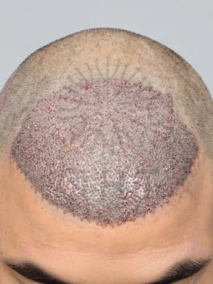 Saying goodbye to baldness. 3500 grafts placed to restore the hairline and mid-scalp.