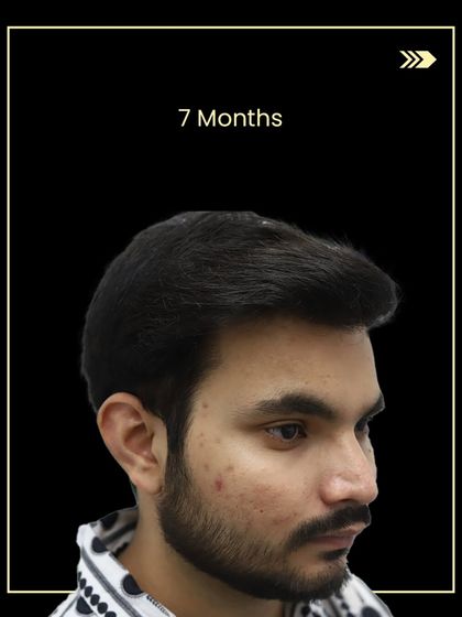 The final result for Ashish after 7 months. The growth is excellent, and the new hairline perfectly frames his face.