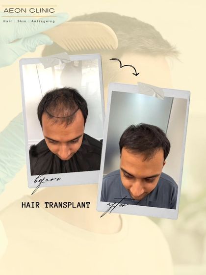 This transformation shows how we address thinning on the top of the scalp, creating a fuller look that restores a youthful appearance.