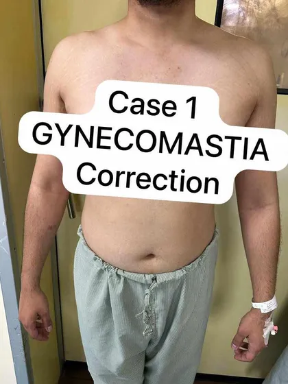 This image shows the straightforward, clean result of a successful gynecomastia correction. Our goal is always to create a natural-looking chest that restores a patient's confidence in their daily life.