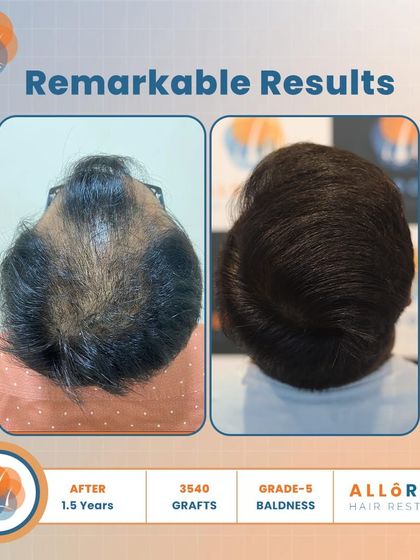 Remarkable results after 1.5 years for a Grade 5 baldness case. Using 3540 grafts, we achieved a dense and natural-looking outcome, as shown in these detailed before-and-after shots.
