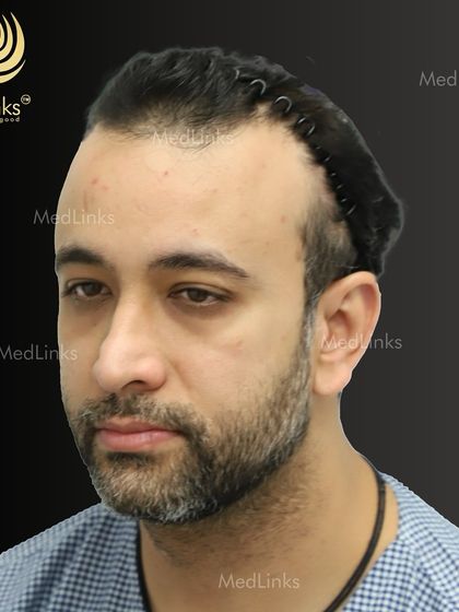 The patient's hair before the procedure, with a hairband pulling back the existing hair to show the full extent of the hair loss.