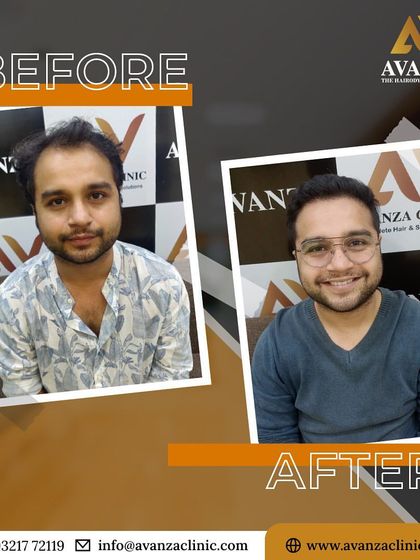 Restoring more than just hair, we restore self-assurance. This client's smile and confident posture in the after photo say it all.