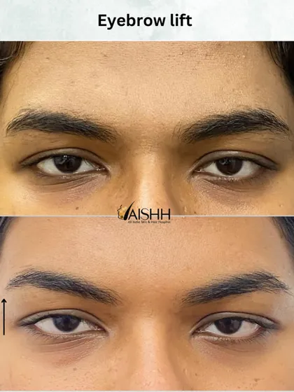 An often-overlooked benefit of treating frown lines is a subtle eyebrow lift. This opens up the eye area and contributes to a brighter, more refreshed look.