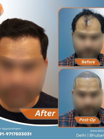 This series shows the complete process for a patient, from the before and post-op stages to the final impressive result. It gives a comprehensive view of the transformation journey.