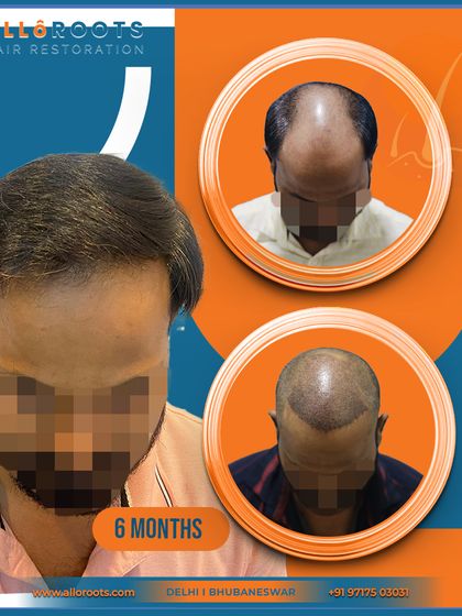 A 6-month progress shot. This image shows significant growth and coverage at the halfway mark, demonstrating that results begin to appear relatively quickly and continue to improve.