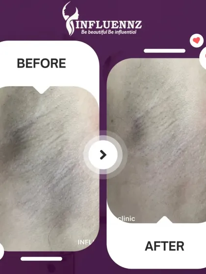 This image showcases the results of another successful underarm pigmentation treatment. The 'after' photo displays a much lighter and more uniform skin tone.