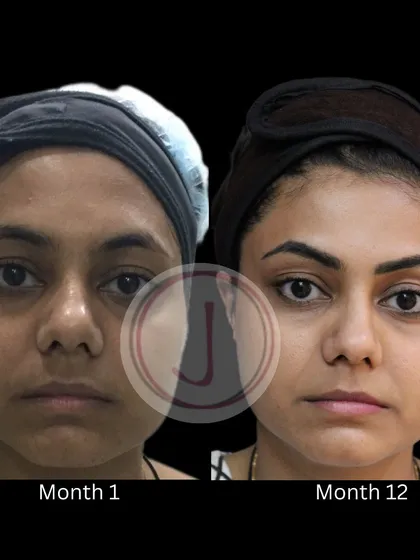This transformation over 12 months shows the incredible long-term benefits of consistent medi-facials. Her skin is visibly brighter, smoother, and more even-toned, proving that regular skin workouts pay off.
