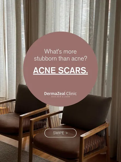 Acne is frustrating, but the scars it can leave behind are often more stubborn. Understanding the difference between a mark and a true scar is the first step toward finding the right treatment to improve your skin's texture.