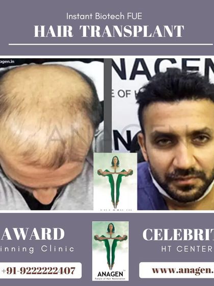 An excellent result after only 8 months. This patient's transformation from significant baldness to a full head of hair is a testament to our advanced techniques.
