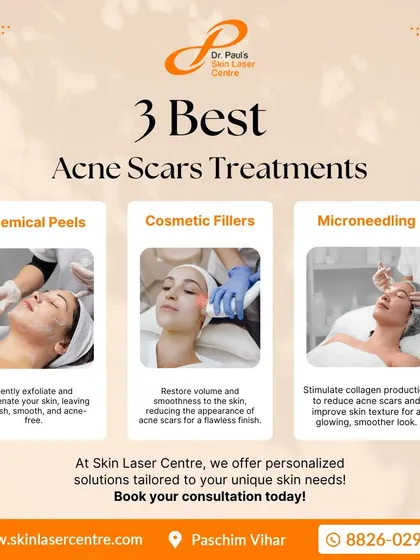 I offer a range of solutions because no two scars are the same. This overview shows my three primary methods for treating acne scars: targeted chemical peels for surface texture, cosmetic fillers for indented scars, and microneedling to rebuild collagen from within.
