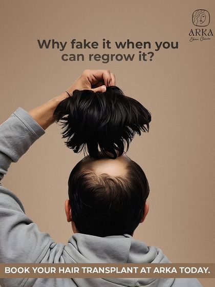Why rely on temporary fixes like hair patches or toupees when you can regrow your own hair? An FUE hair transplant gives you a permanent, natural solution that you can wash, style, and live with, worry-free.