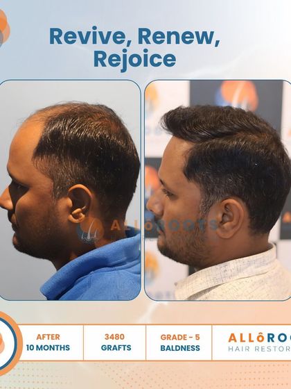 Revive, Renew, Rejoice. This 10-month result for a Grade 5 baldness case, using 3480 grafts, shows a complete restoration. The images from all angles prove that a full head of hair is an achievable goal.