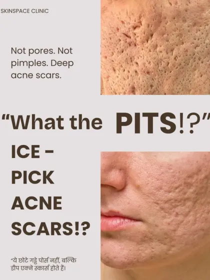 Many people mistake deep acne scars for large pores. These are actually ice-pick scars, which form deep in the skin and cannot be fixed with creams. We use targeted medical procedures to repair this kind of damage.