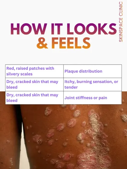 Psoriasis typically appears as red, raised patches with silvery scales, but it can also feel itchy or tender and cause joint stiffness. Recognizing these signs early is important for seeking timely medical care.
