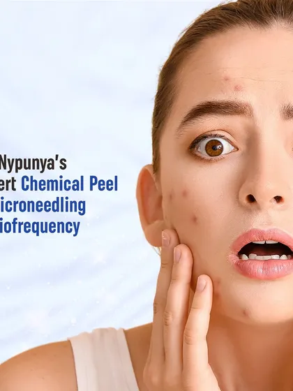If you're feeling overwhelmed by monsoon acne breakouts, we have expert treatments that can help. A combination of chemical peels and fractional microneedling radiofrequency can effectively tackle both active acne and scarring.
