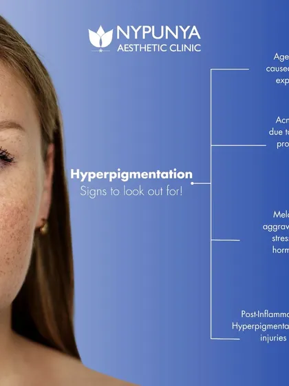 This infographic explains the different signs of hyperpigmentation to look out for. These include age spots from sun exposure, post-inflammatory marks from acne, and melasma, which is often aggravated by hormones.