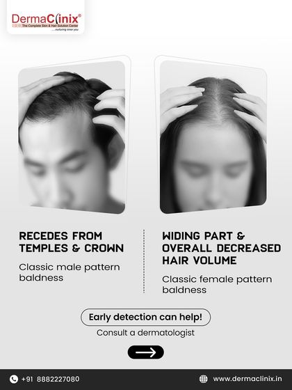 Here we illustrate the classic signs of DHT-related hair loss: a receding hairline and crown baldness in men, and a widening part with decreased volume in women. Early detection is key.