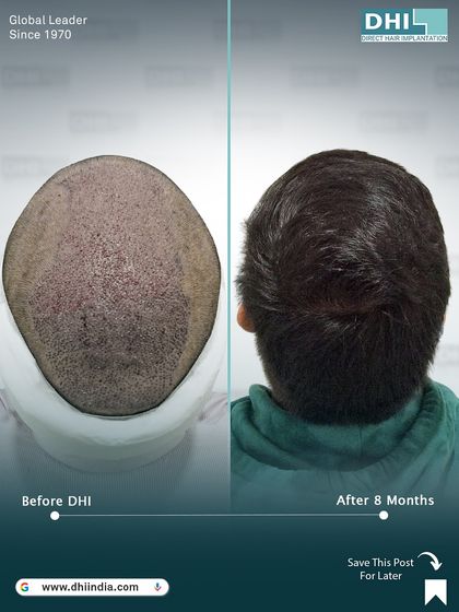 A before and after of the crown area 8 months post-transplant. This image shows the incredible density achieved for a patient with Atypical Andro Genetic Alopecia after implanting 7,612 hairs.