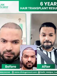 Hair Transplant Surgery