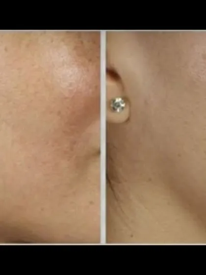 Unwanted facial hair is a common concern, and this before and after result demonstrates the effectiveness of my laser hair reduction treatment. After a course of sessions, the hair is permanently reduced, leaving the skin smooth and clear, boosting confidence.