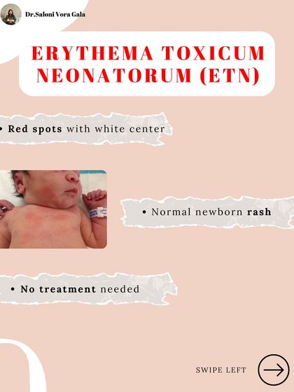 Erythema Toxicum Neonatorum (ETN) looks like red spots with a white center. It's a normal and very common newborn rash that requires no treatment and resolves on its own.