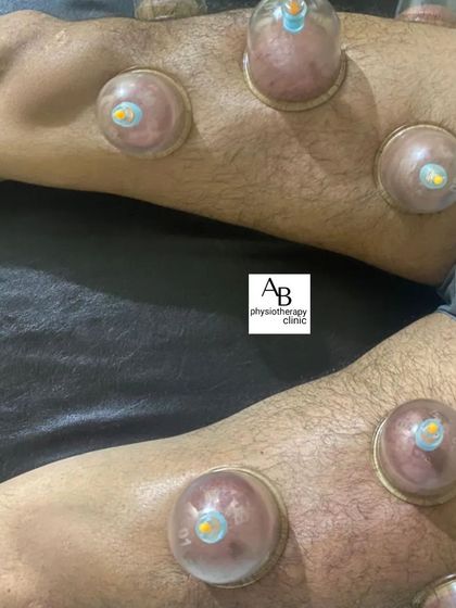Another view of cupping therapy applied to the legs, a common treatment for runners and athletes to accelerate muscle recovery.