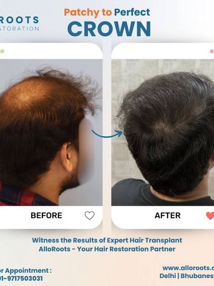 Crown area thinning is a common concern. These images show a perfect restoration of the crown, transforming a patchy area into a full, dense look that blends seamlessly with the surrounding hair.