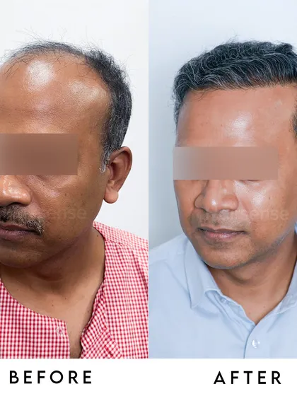 This transformation shows how we can turn back the clock on hair loss. By carefully reconstructing the hairline and adding density throughout, we achieve a result that is full, natural, and completely revitalizes our patient's look.