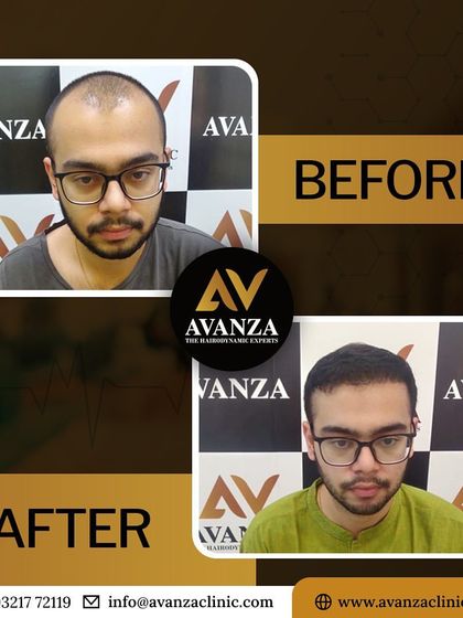 A clear and effective before and after. We addressed the client's baldness, giving him a full head of hair and a more youthful frame for his face.