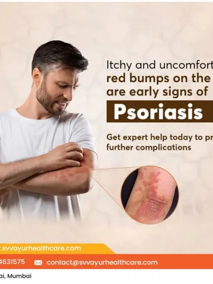 Psoriasis can be a persistent and uncomfortable condition, often appearing as itchy, red bumps. It is important to seek expert help to manage the symptoms and prevent complications. My Ayurvedic treatments focus on managing these flare-ups and addressing the internal triggers of psoriasis.
